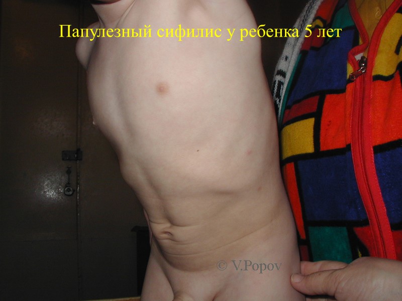 Папулезный сифилис у ребенка 5 лет